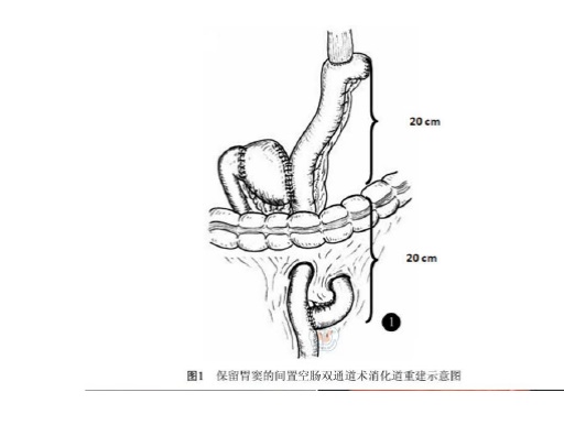保胃新术式让胃癌患者生活更舒心