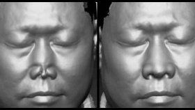 整形外科通過3D掃描打印設計完成全鼻再造一例