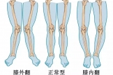 “X型腿”、“O型腿”應該怎么治療呢？都有哪些治療策略？