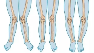 “X型腿”、“O型腿”應該怎么治療呢？都有哪些治療策略？