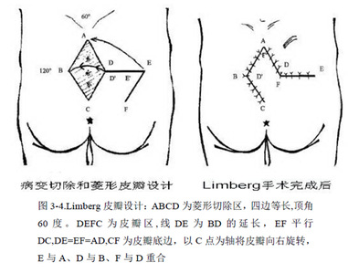 徐州醫科大學附屬醫院肛腸科成功開展首例藏毛竇改良limberg皮瓣術