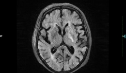 急救中心成功静脉溶栓1例90岁超高龄缺血性脑卒中患者