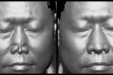 整形外科通过3D扫描打印设计完成全鼻再造一例