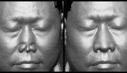 整形外科通过3D扫描打印设计完成全鼻再造一例