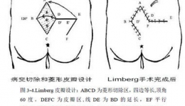 肛肠科成功开展首例藏毛窦改良Limberg皮瓣术