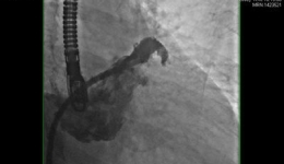 徐医附院心内科完成第一例经皮左心耳封堵术