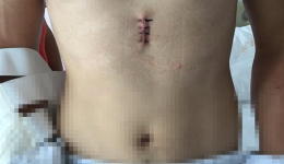 “一枪四鸟”，把胸腔镜的微创做到极致——徐医附院用剑突下单孔胸腔镜技术切除双侧肺大疱及交感神经链