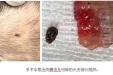 我院整形外科收治一名被蜱虫叮咬的女童