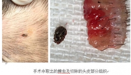 我院整形外科收治一名被蜱虫叮咬的女童