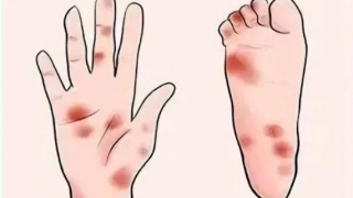 治疗后手脚 “遭罪”？这份手足综合征应对指南请收好