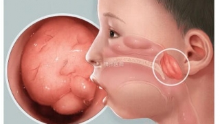 3月3日“全国爱耳日” | 孩子“听不清、睡不沉”？寒假收尾赶紧带孩子查查这个问题！