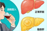 别让 “小酌怡情”，酿成肝脏的 “脂肪危机”