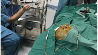 精准消融！徐医附院微创疗法为结节性硬化症癫痫患儿重燃希望